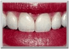 Description: After Tooth Bonding Procedure