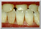 Description: Before Dental Cap Procedure