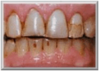 Description: Before Tooth Veneer Procedure