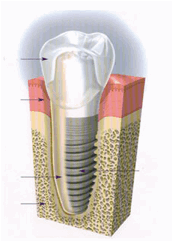 Description: Dental Implant picture