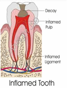 Inflamed Tooth